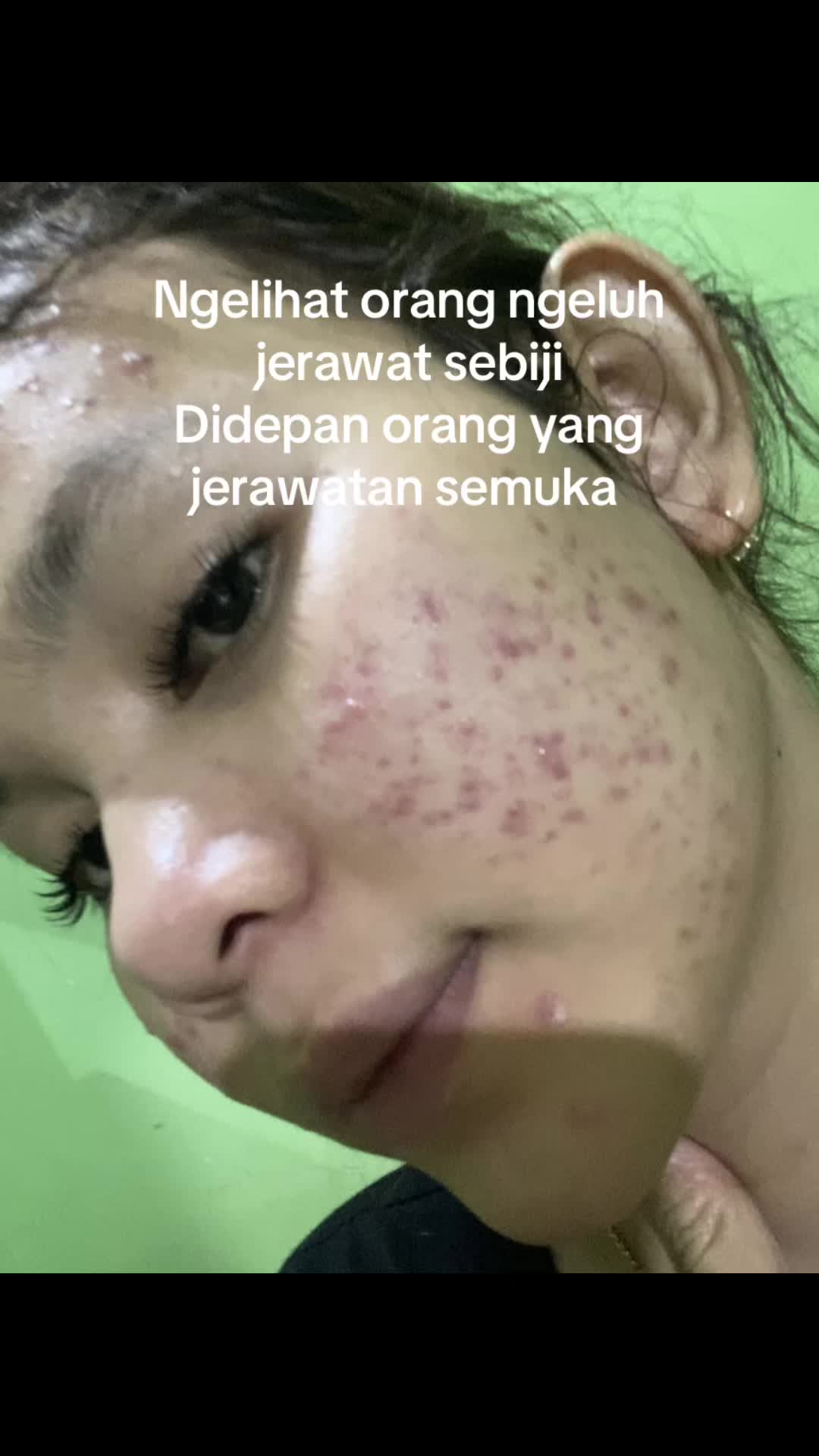 @Natha | Acne fighter
