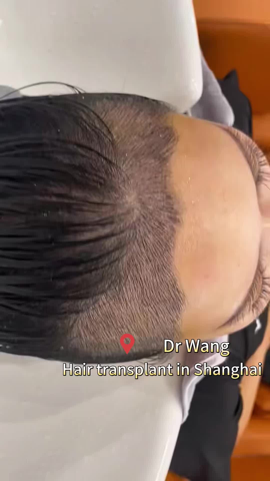 @HAIR TRANSPLANT WANG🇨🇳