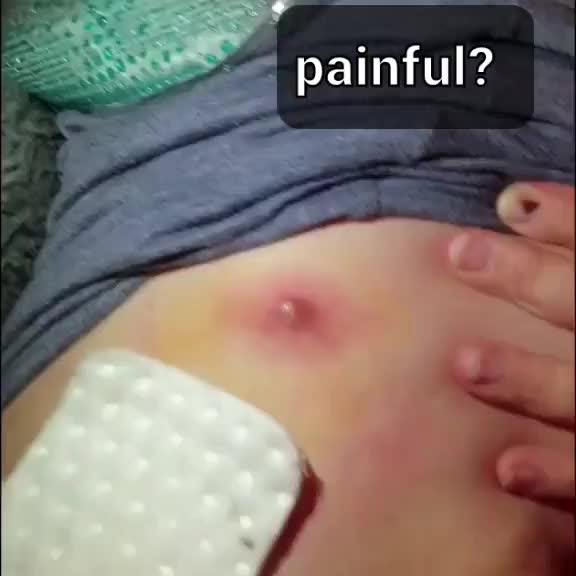 @Pimple Pooping