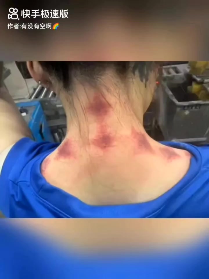 @thích cạo gió