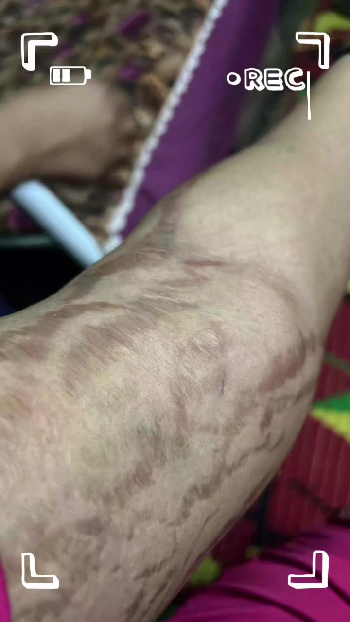 @drmanal " لعلاج التشققات "