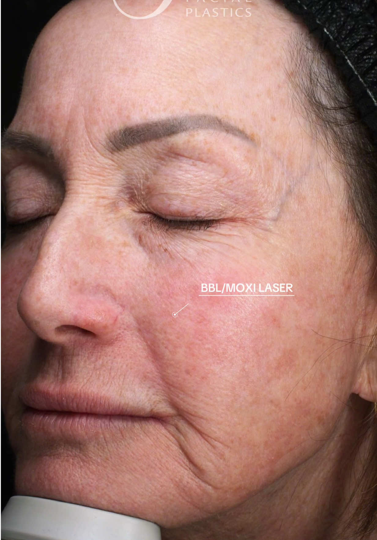 @Smith Facial Plastics
