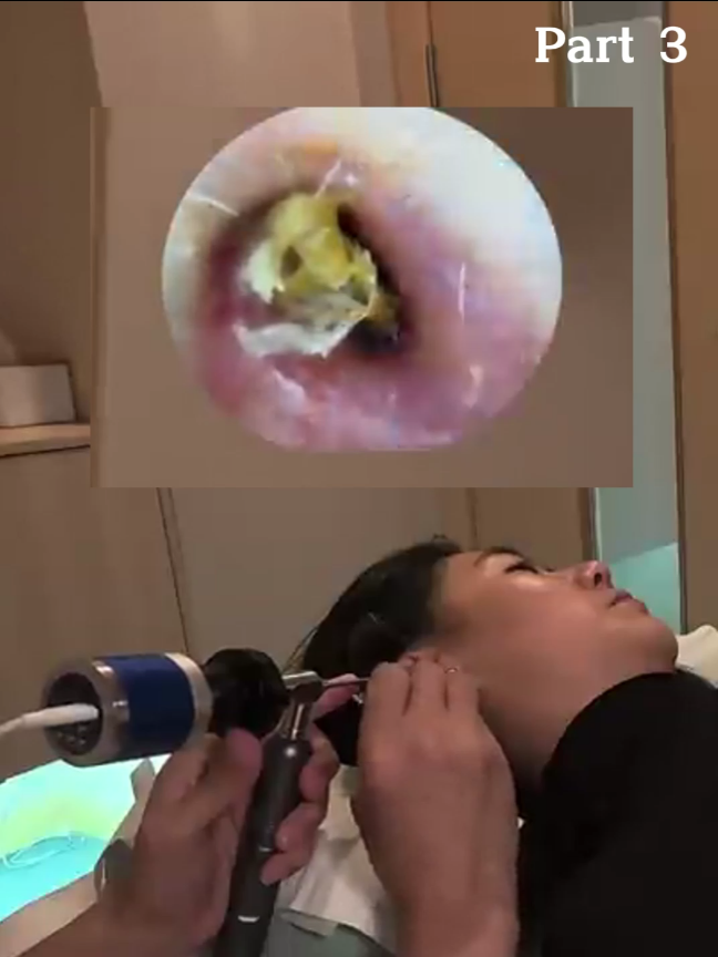 @ASMR Ear Cleaning