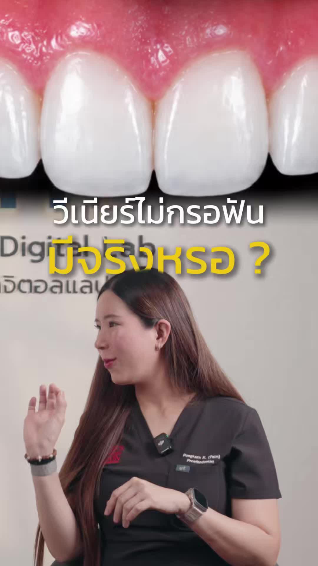 @หมอป่องสวยมาก veneer 🦷