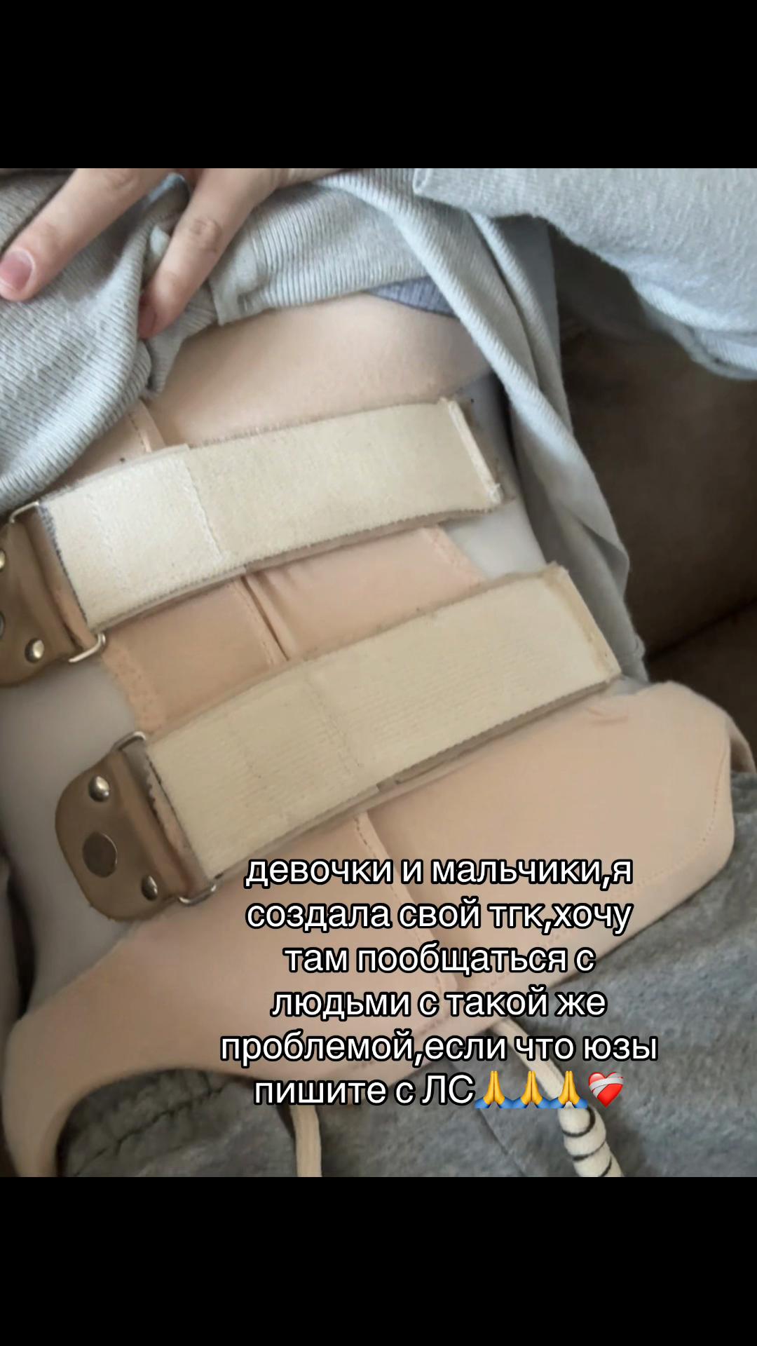 @Scoliosis