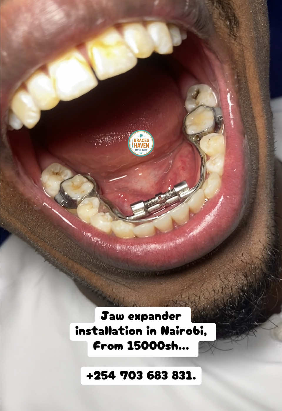 @Braces Haven Nairobi Dental