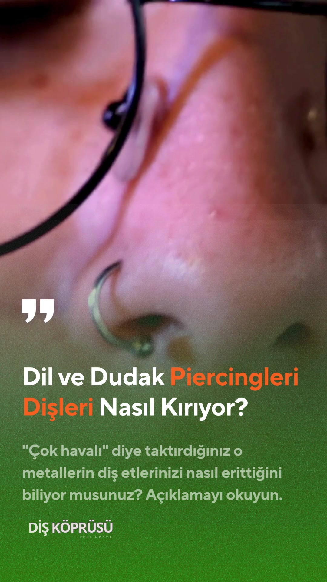 @Diş Köprüsü | Yeni Medya