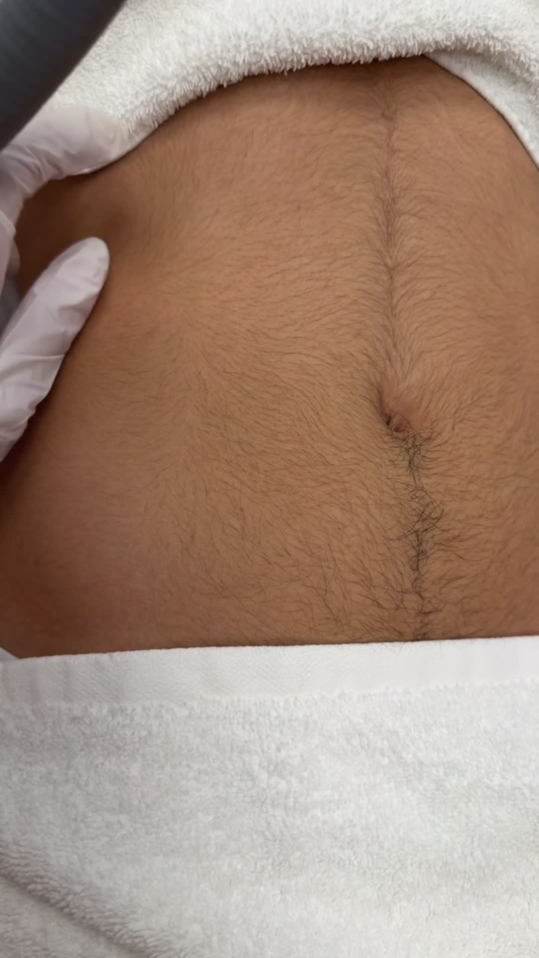 @Laserhaarentfernung D&uuml;sseldorf