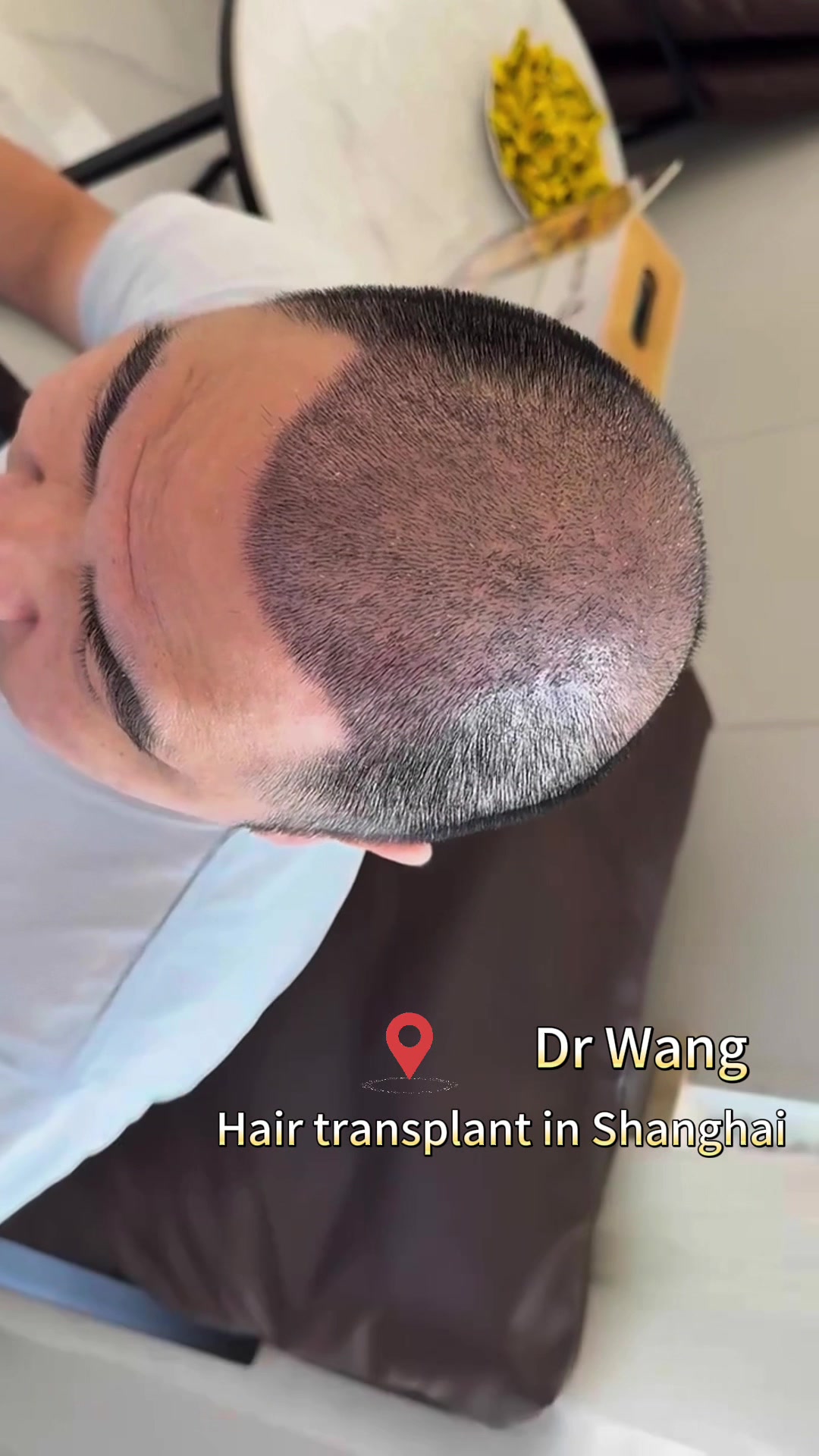 @HAIR TRANSPLANT WANG🇨🇳