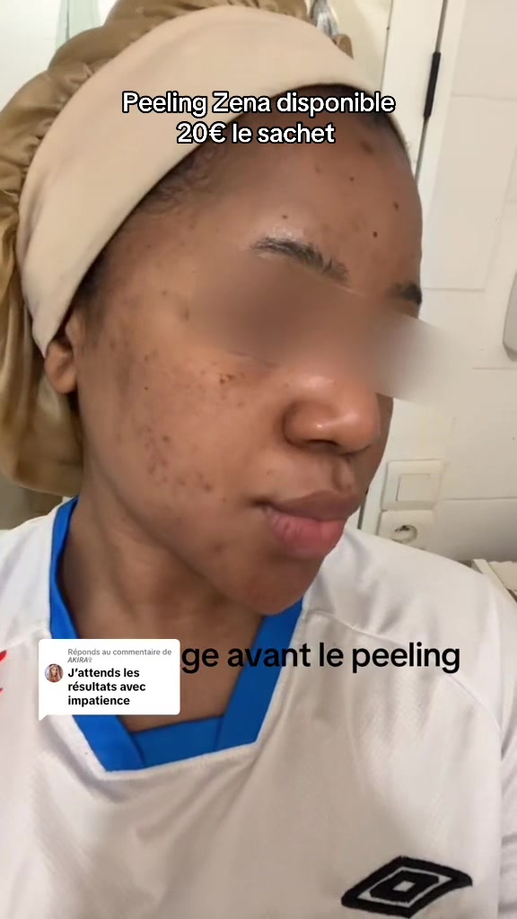 @peeling_zena
