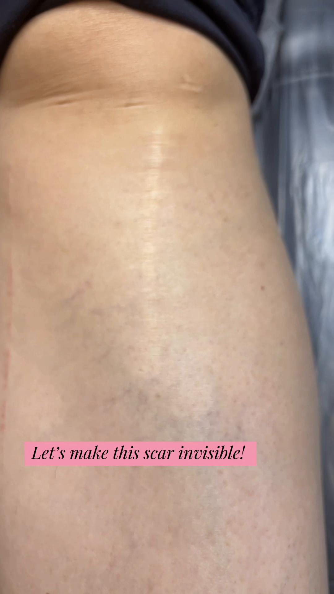 @Invisibleskinhelp