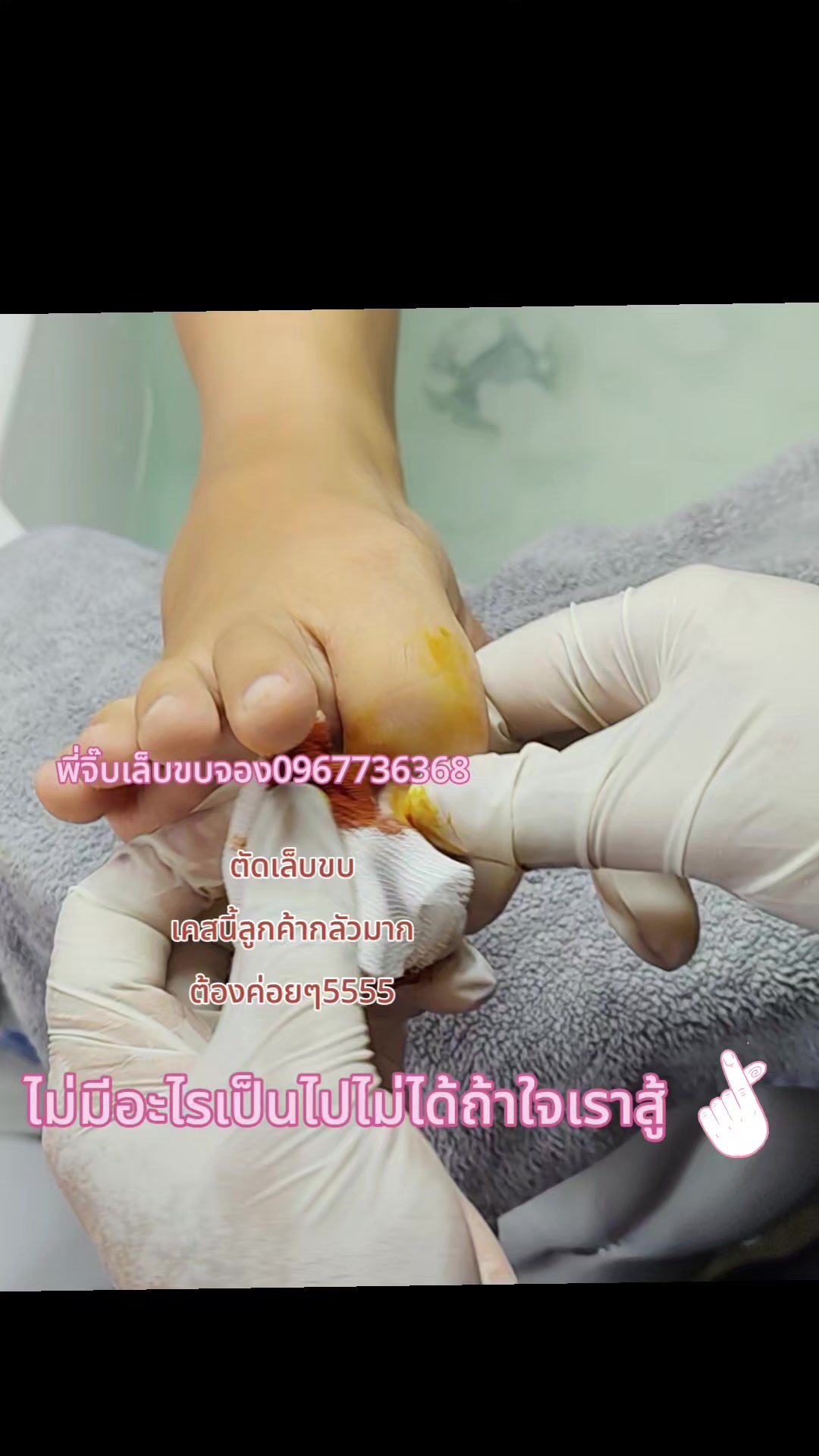 @เล็บขบหาดใหญ่byจิ๊บ