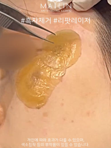 @메이린의원대구점