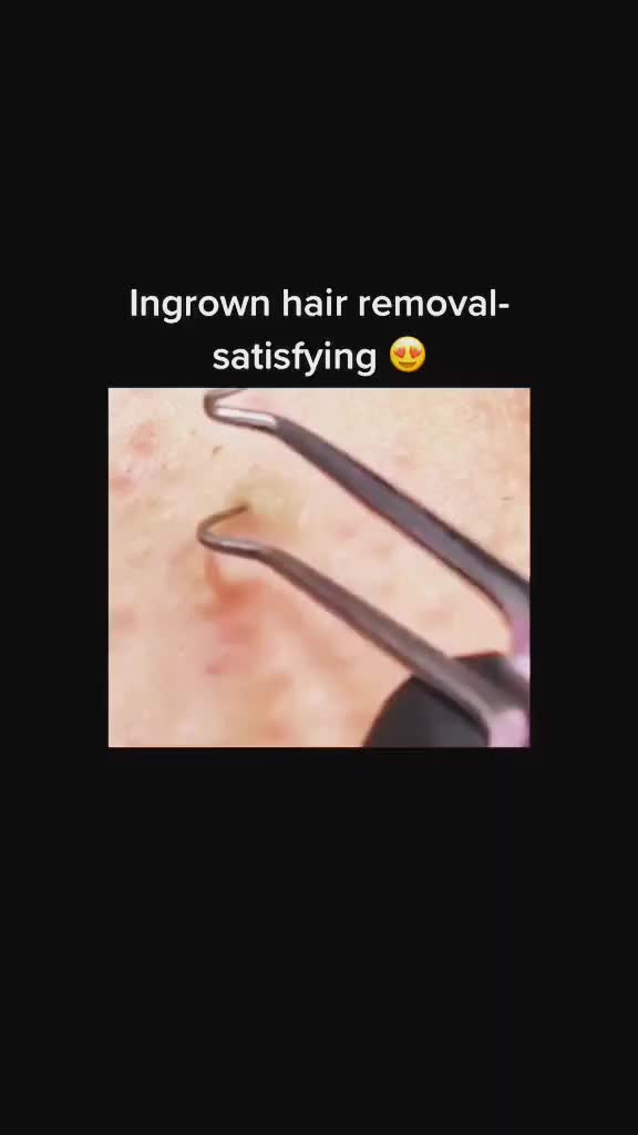 @Pimple Pooping