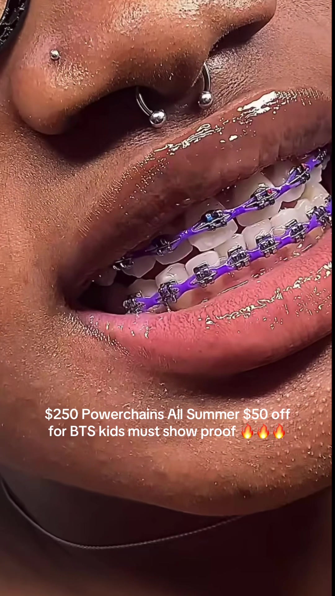 @bracesjunkie