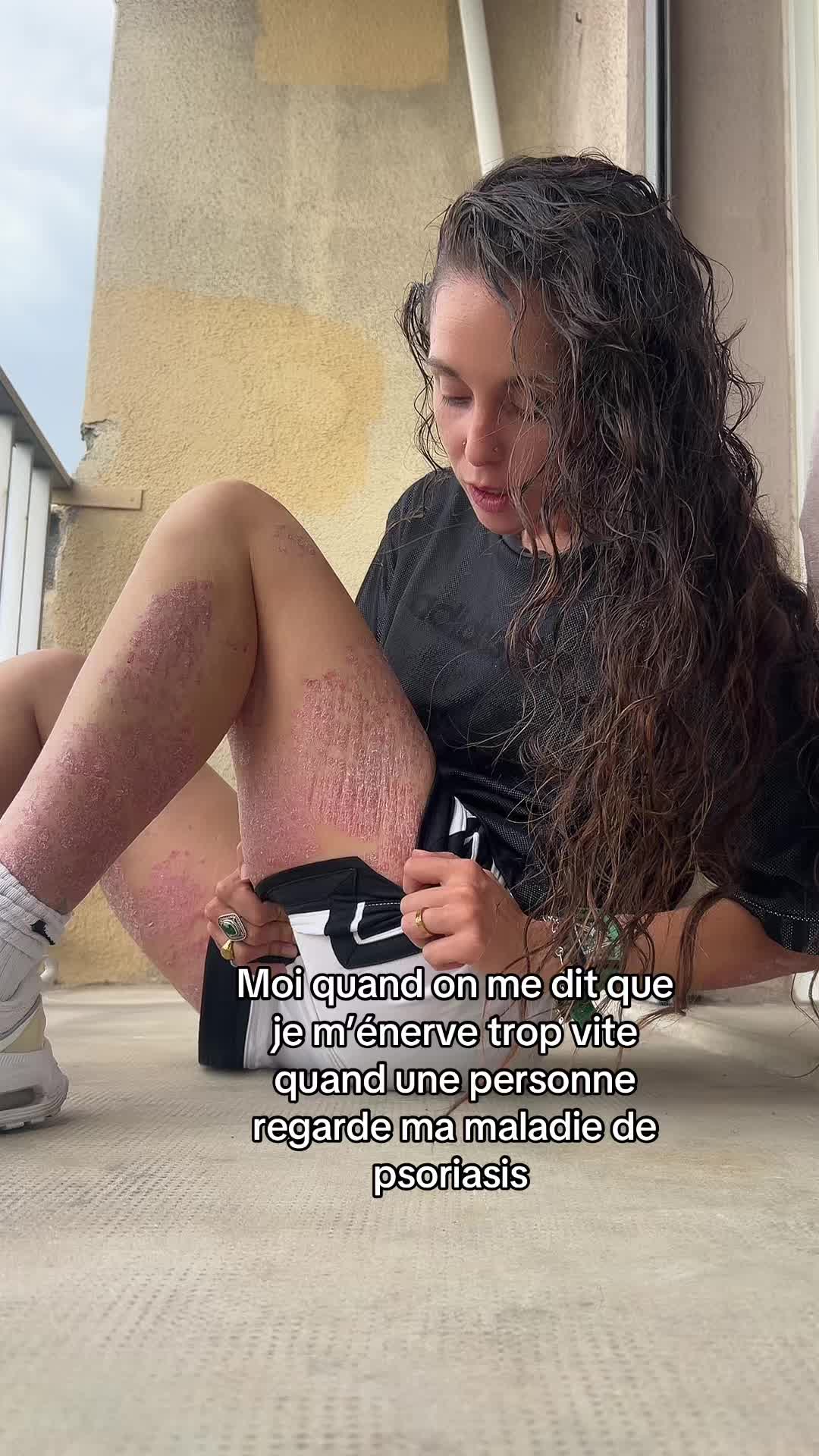 @lyla_psoriasistyle