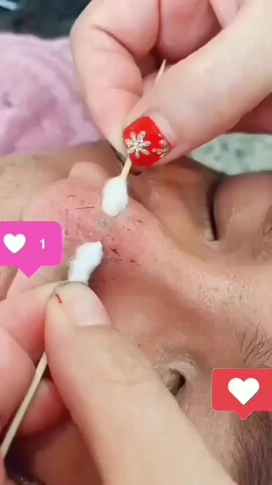 @Pimple Pooping