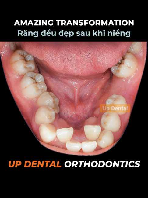 @Nha khoa niềng răng Up Dental