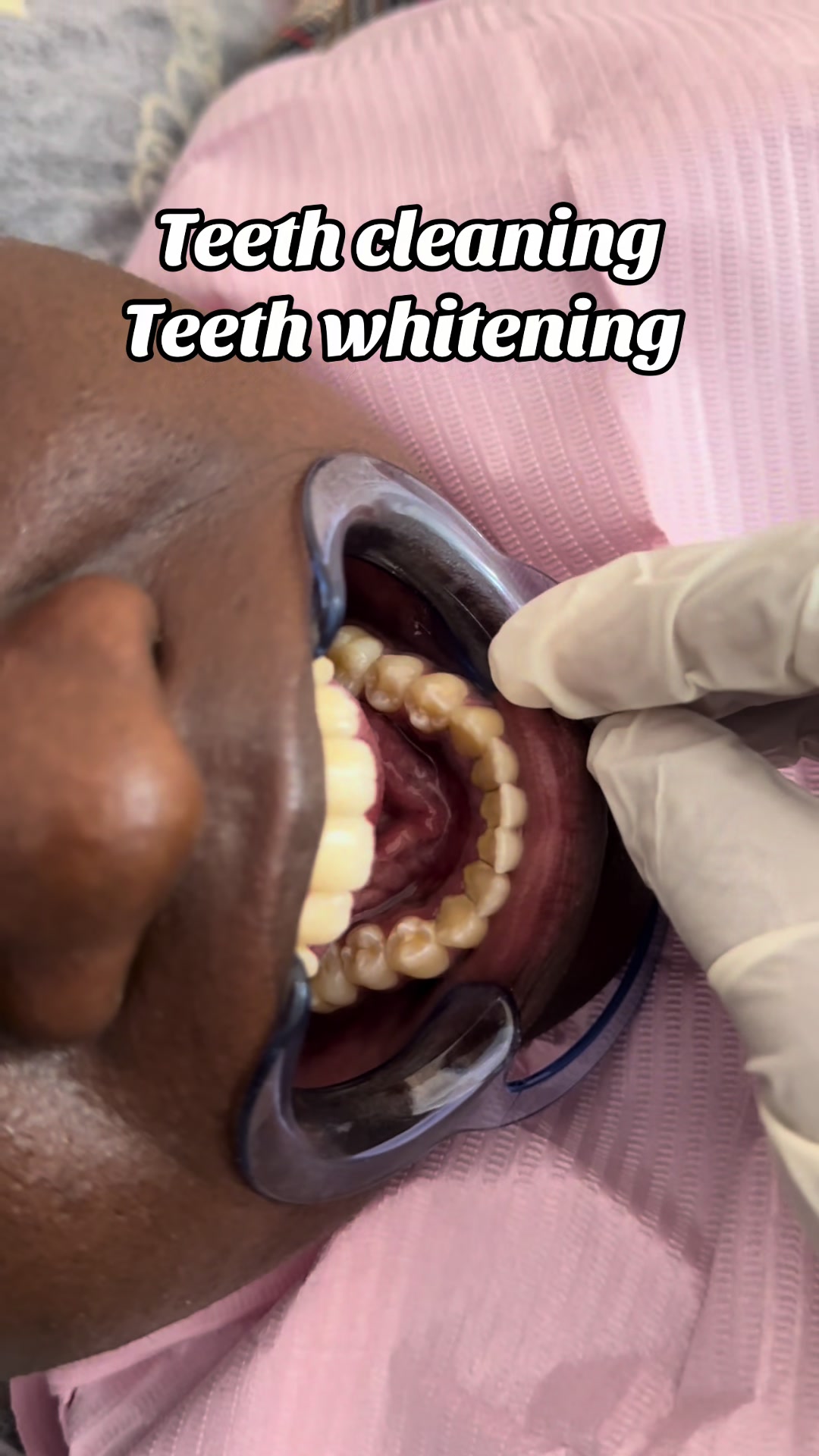 @Teethwhitening—MartGlow Avenue
