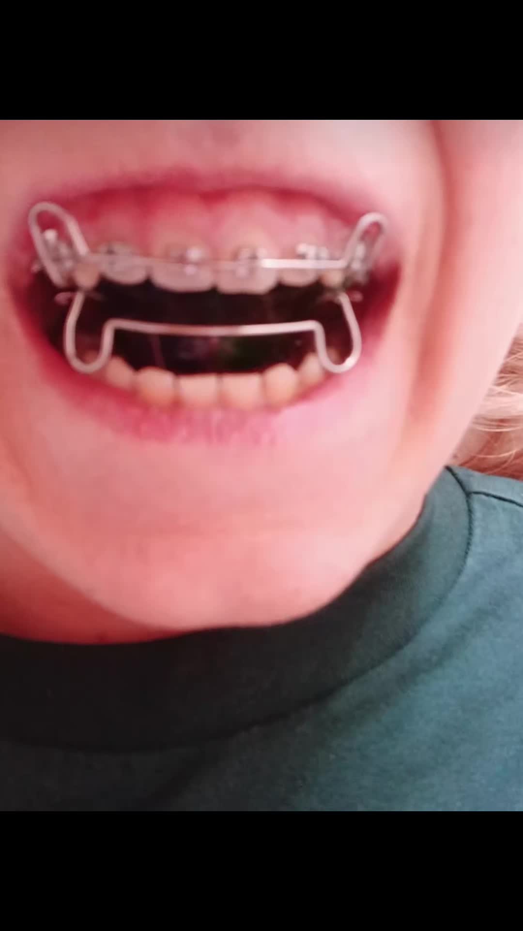 @Zahnspangen Club/  Braces Site