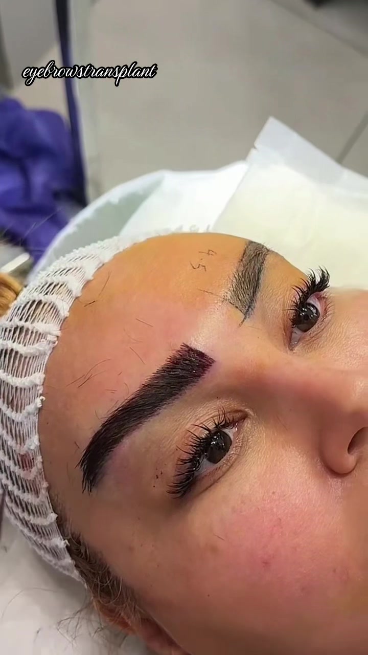@Eyebrows Transplant