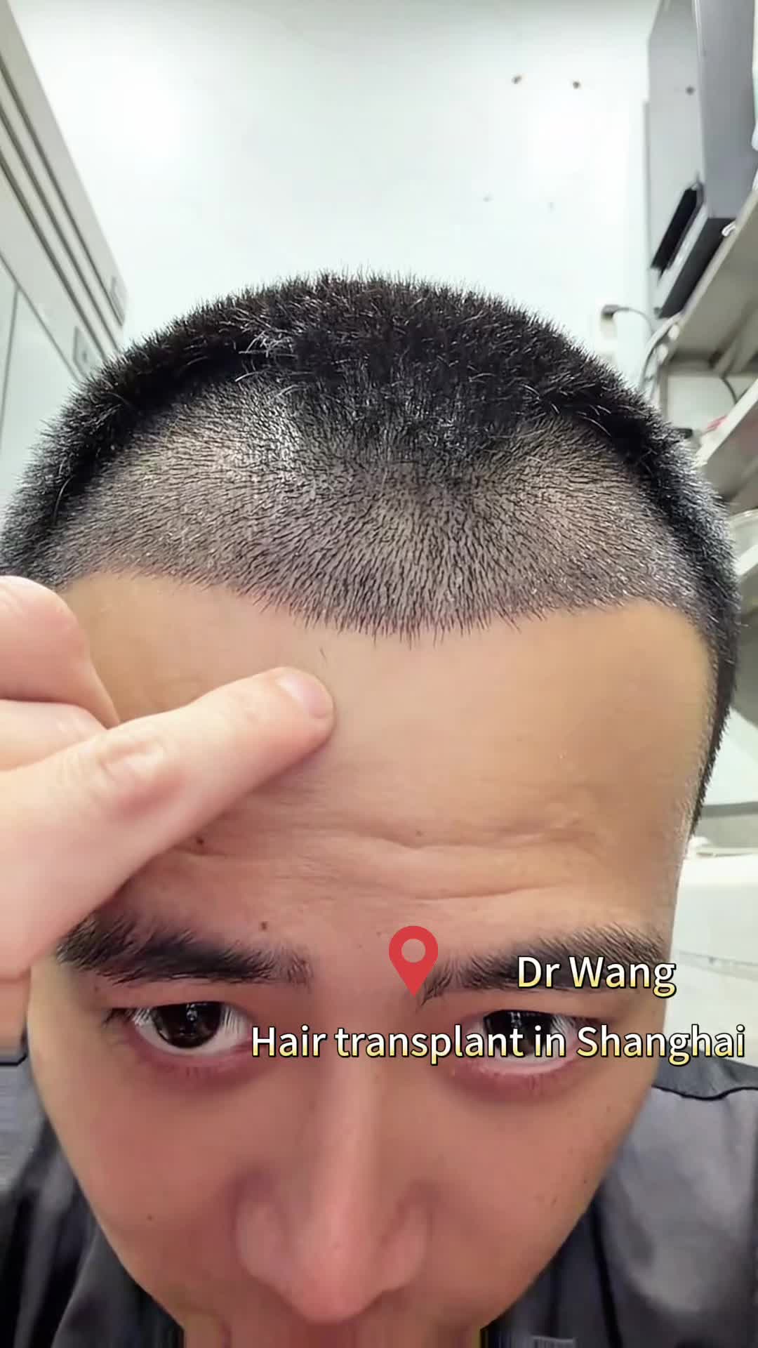 @HAIR TRANSPLANT WANG🇨🇳