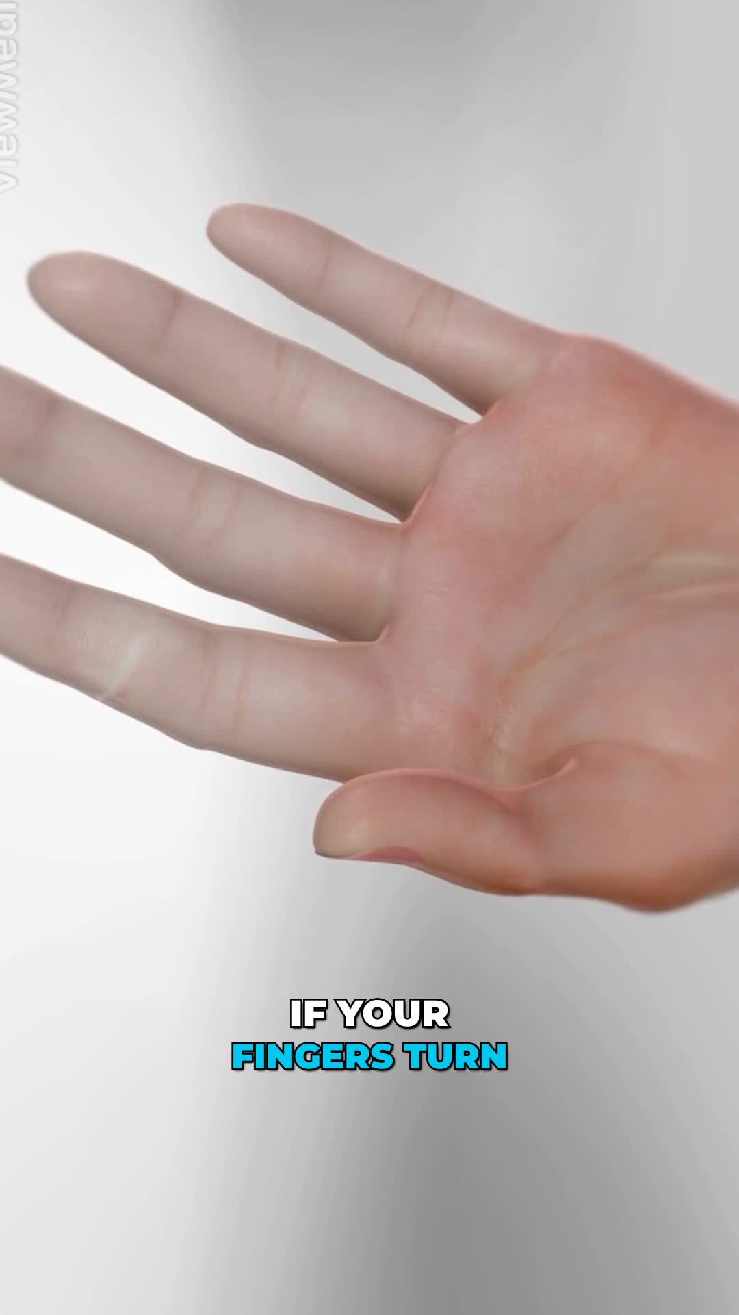 @Viz Medical