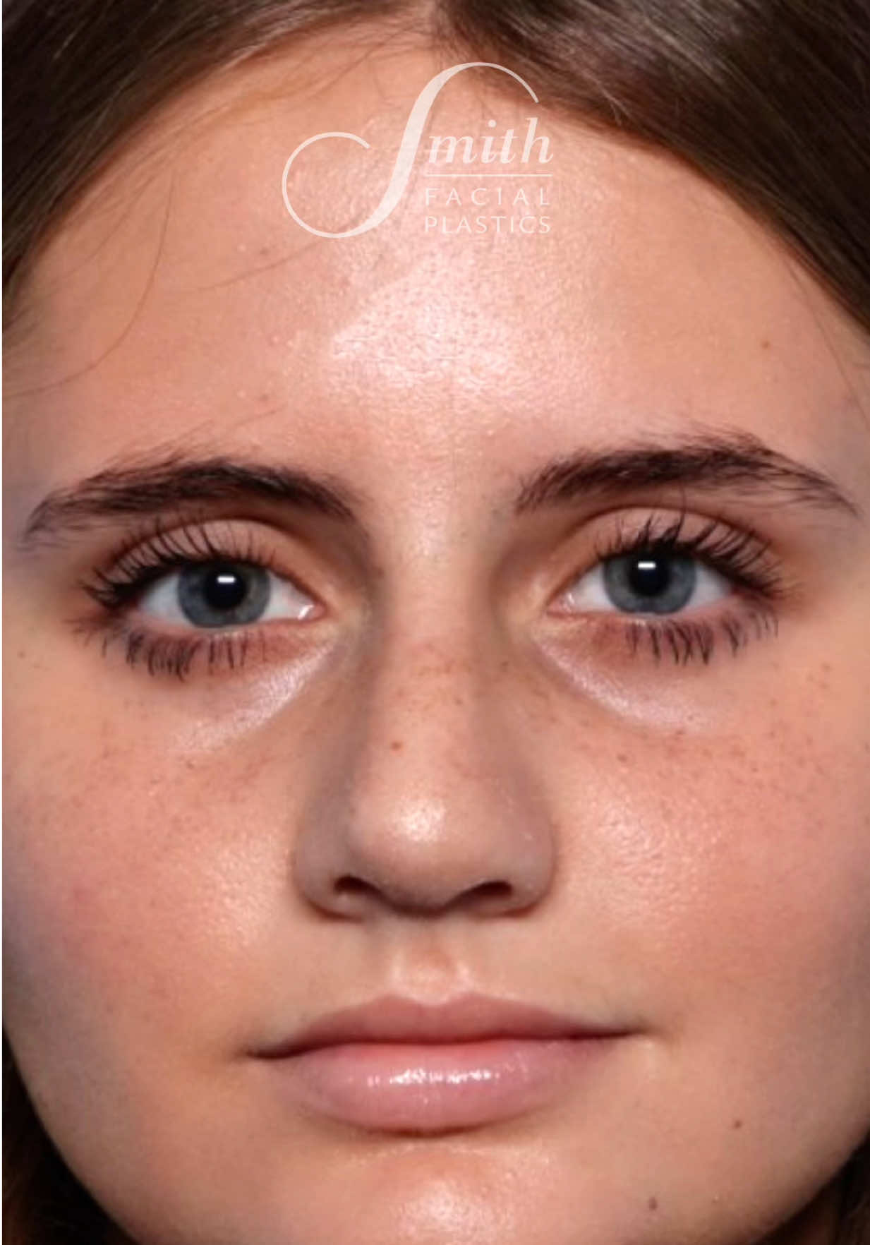 @Smith Facial Plastics