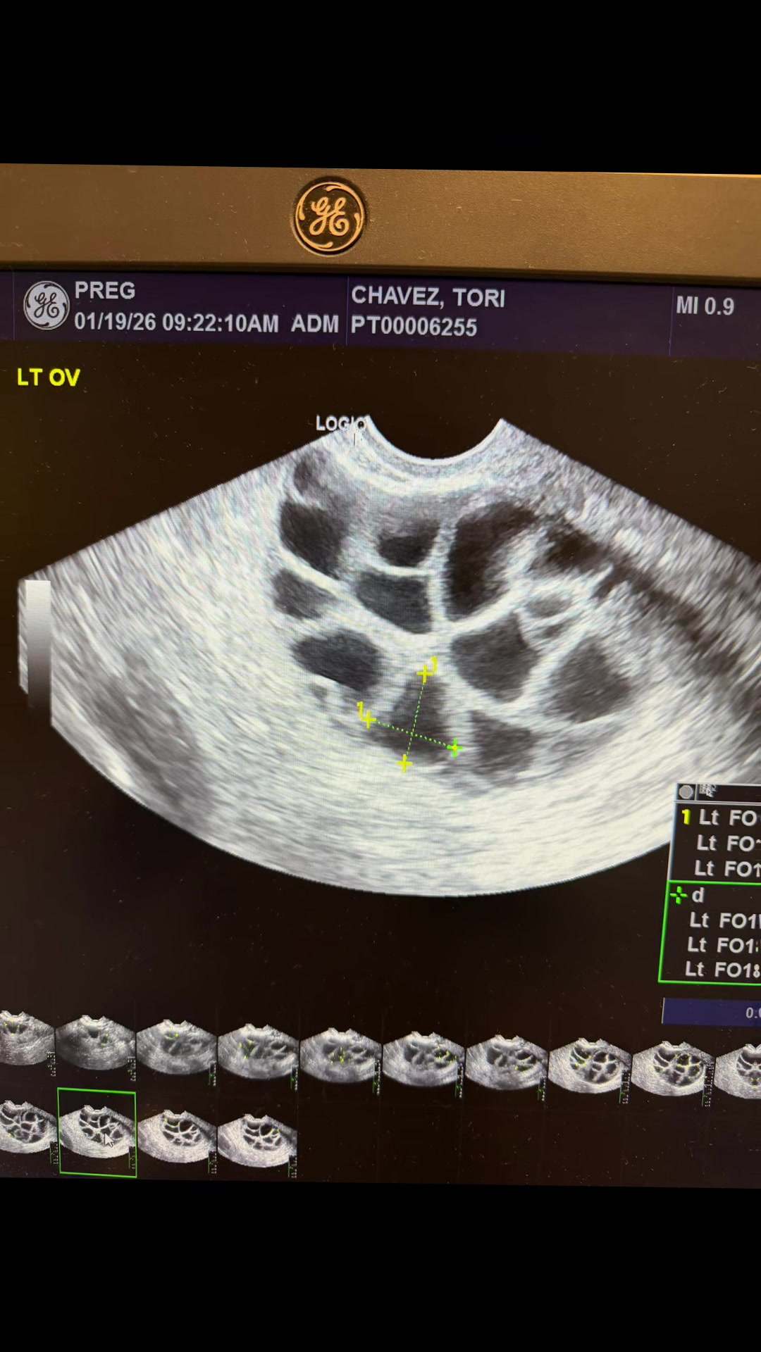 @🌻Tori🤍Marie🌻 IVF journey 💉