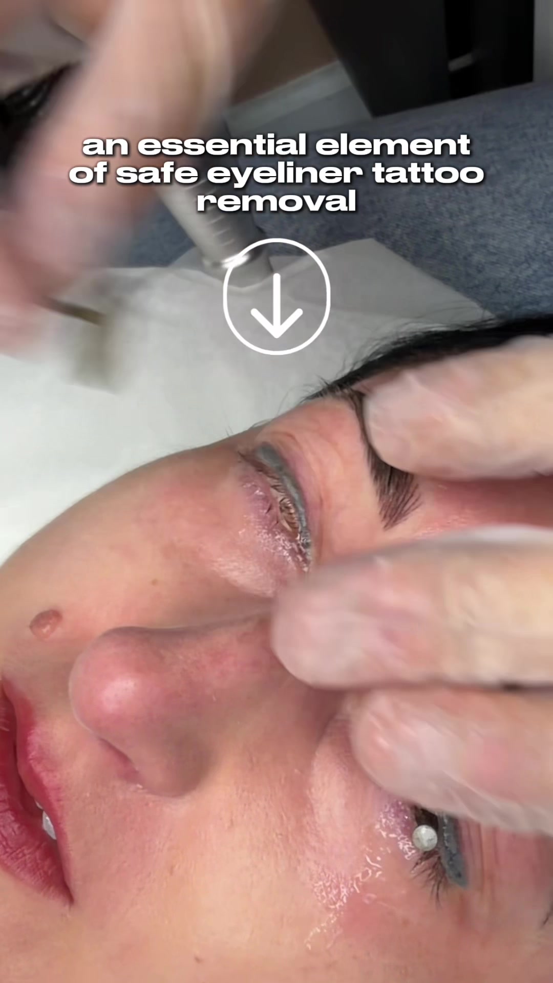@Safe Eyebrows Tattoo Removal🗽