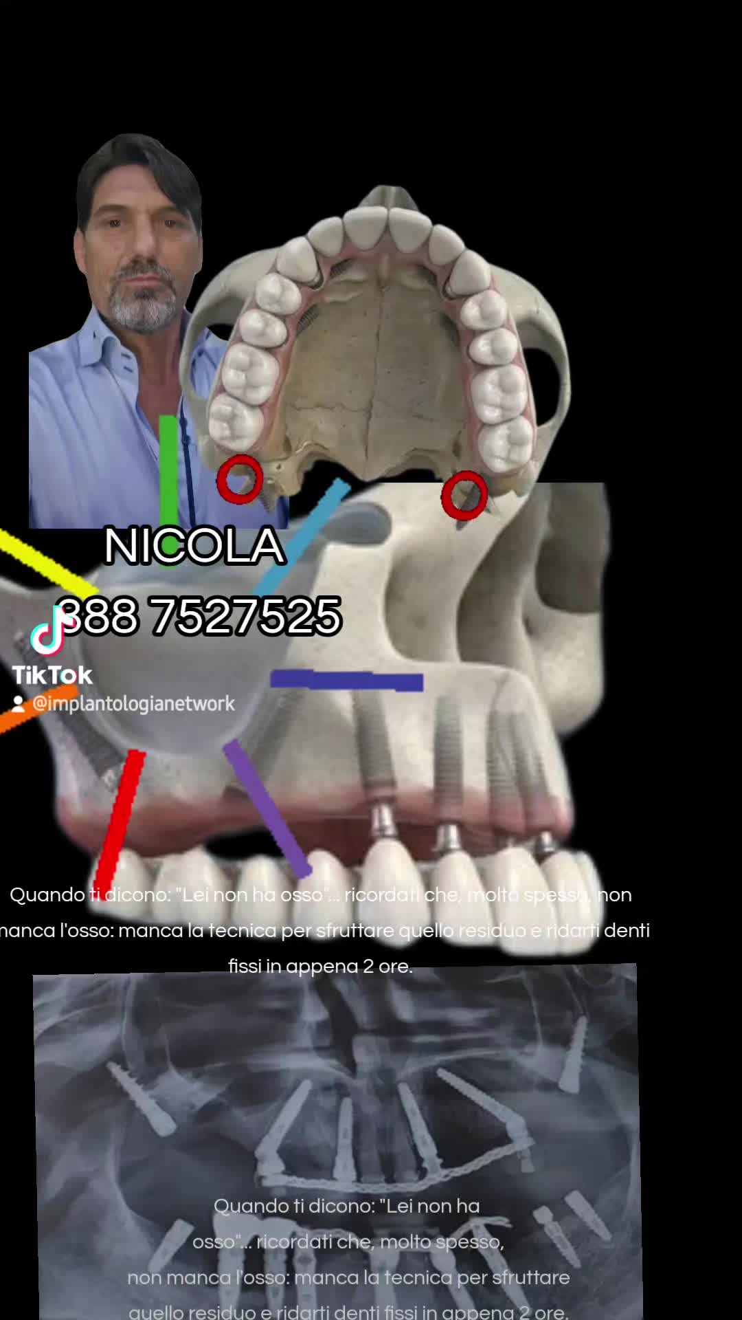 @Implantologiaprezzi