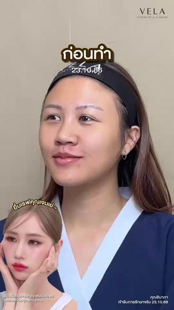 @เวลาคลินิก ตาสองชั้น ถุงใต้ตา