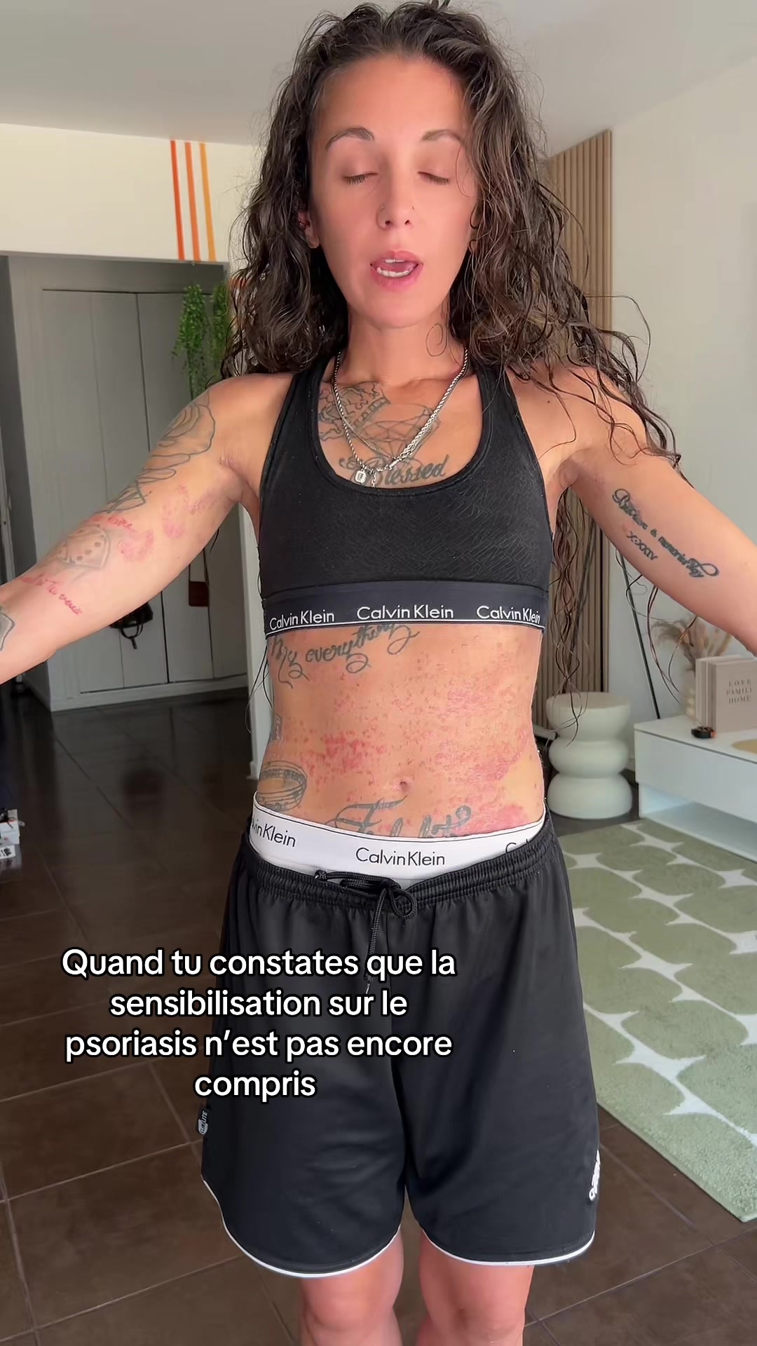 @lyla_psoriasistyle