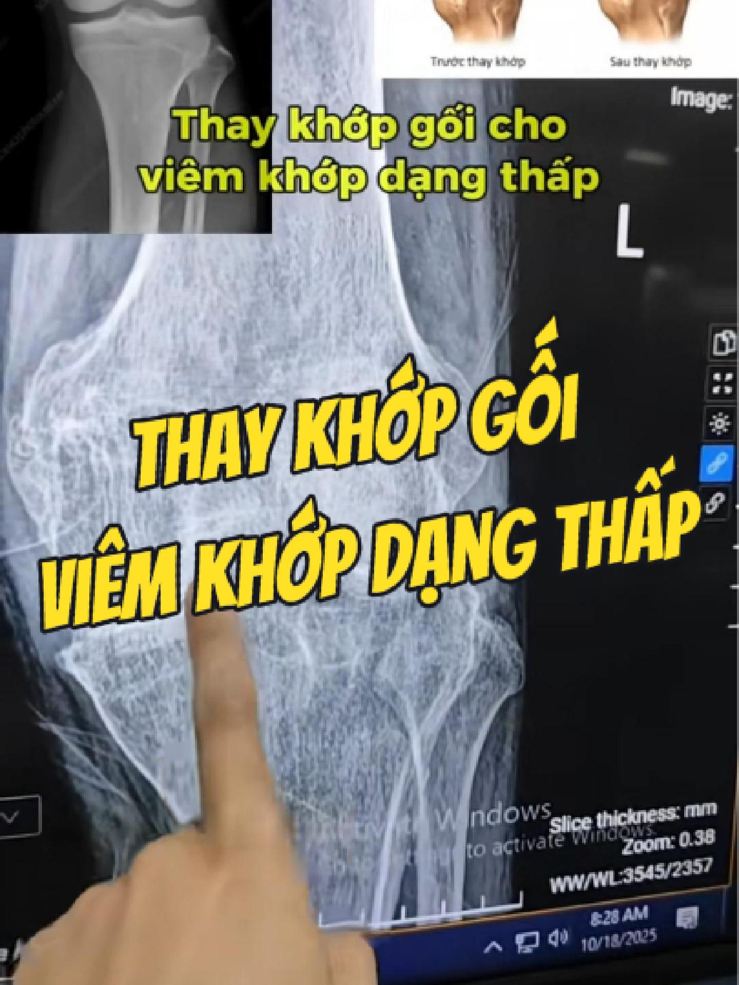 @Chuy&ecirc;n gia xương khớp