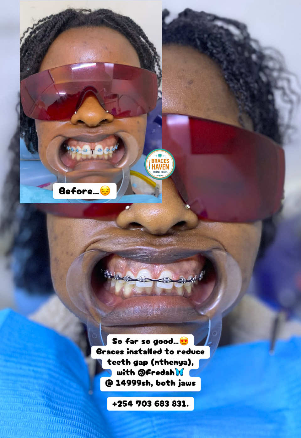@Braces Haven Nairobi Dental