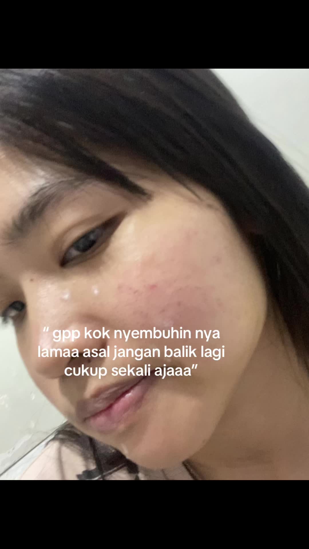 @acnefighter ew