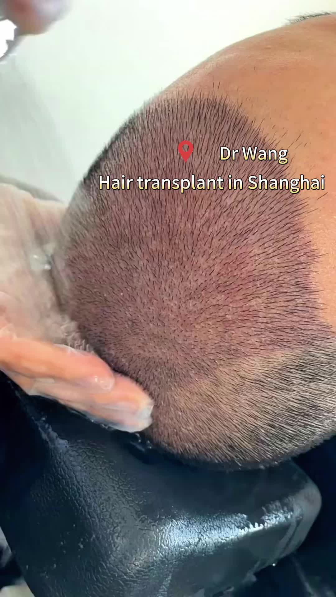 @HAIR TRANSPLANT WANG🇨🇳