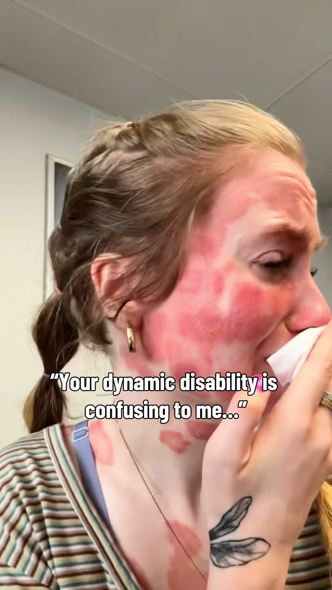@indias_psoriasis