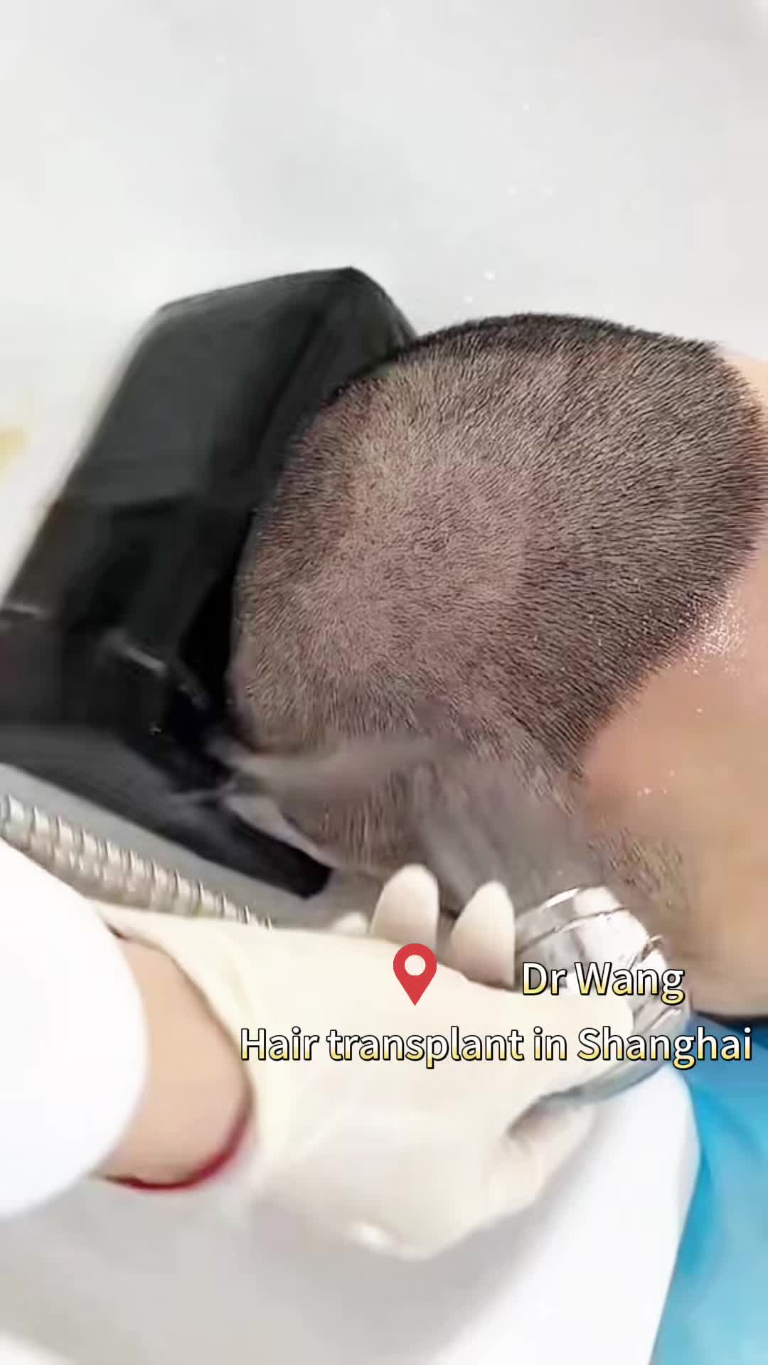@HAIR TRANSPLANT WANG🇨🇳