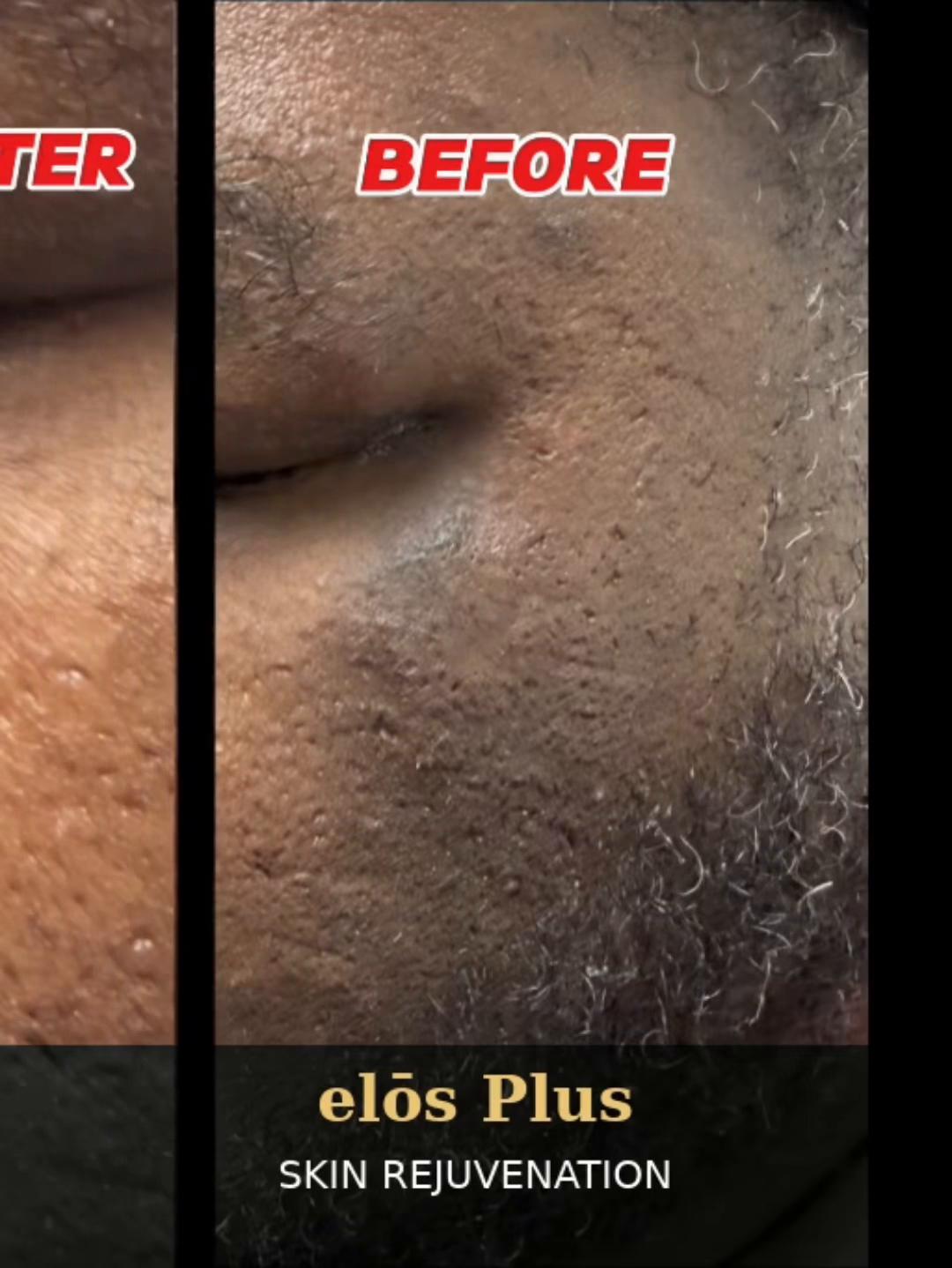 @Zeiva laser /Dearborn MI