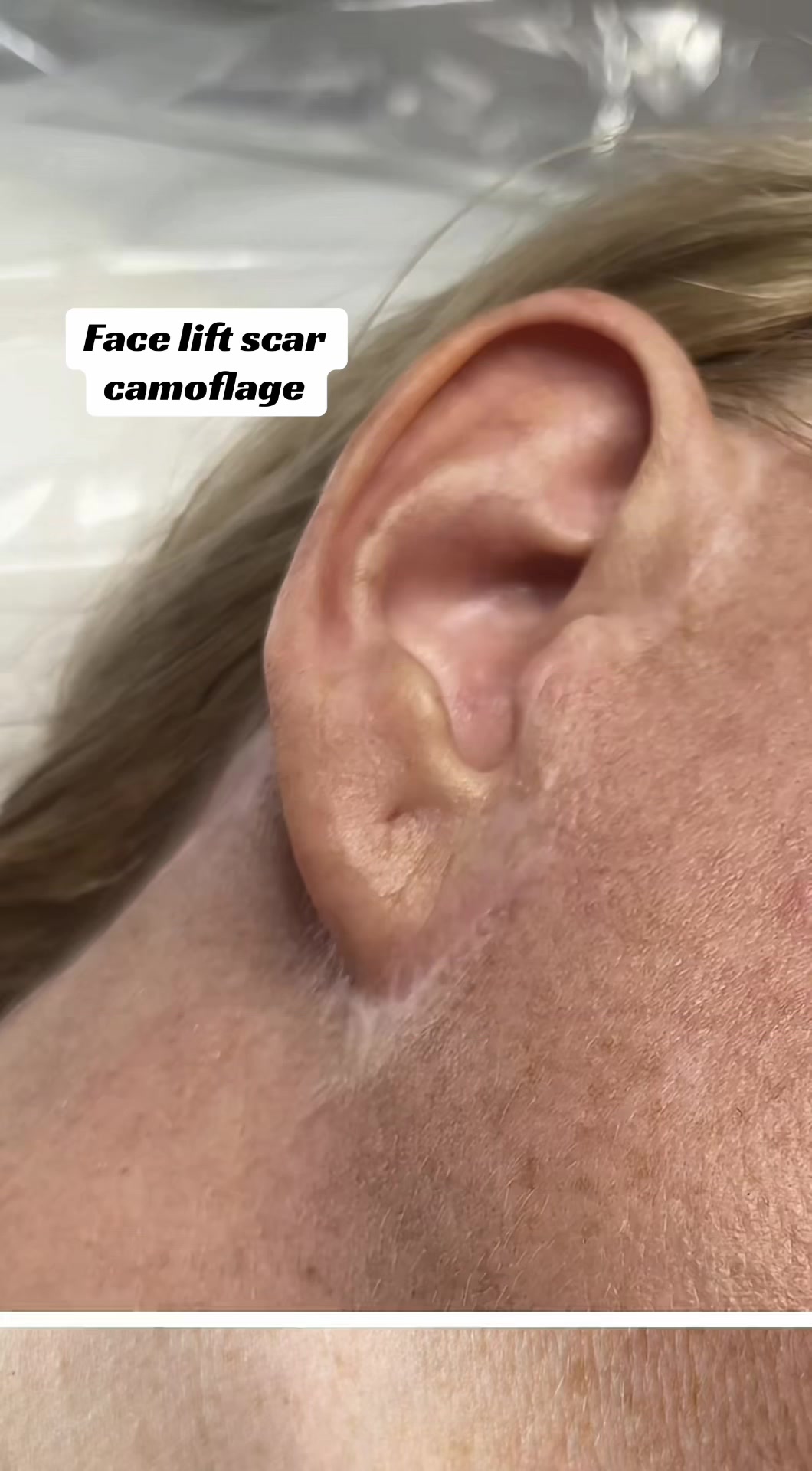 @Invisibleskinhelp