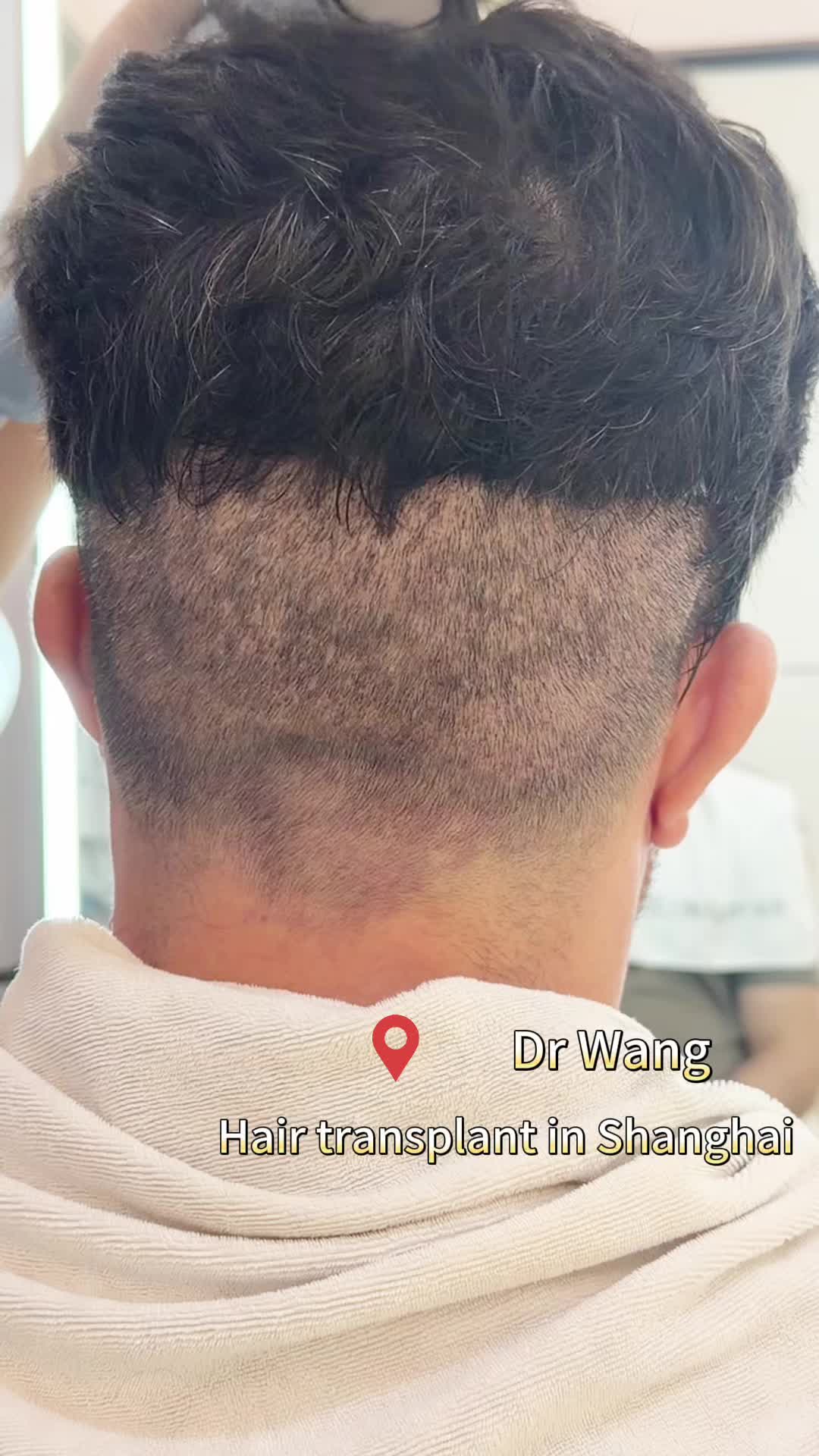 @HAIR TRANSPLANT WANG🇨🇳