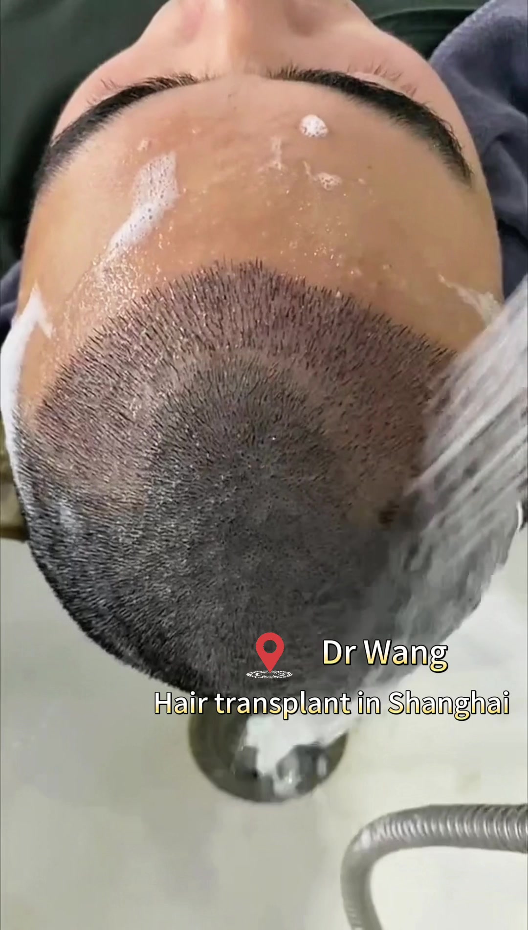 @HAIR TRANSPLANT WANG🇨🇳