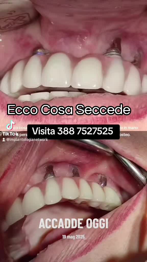 @Implantologiaprezzi