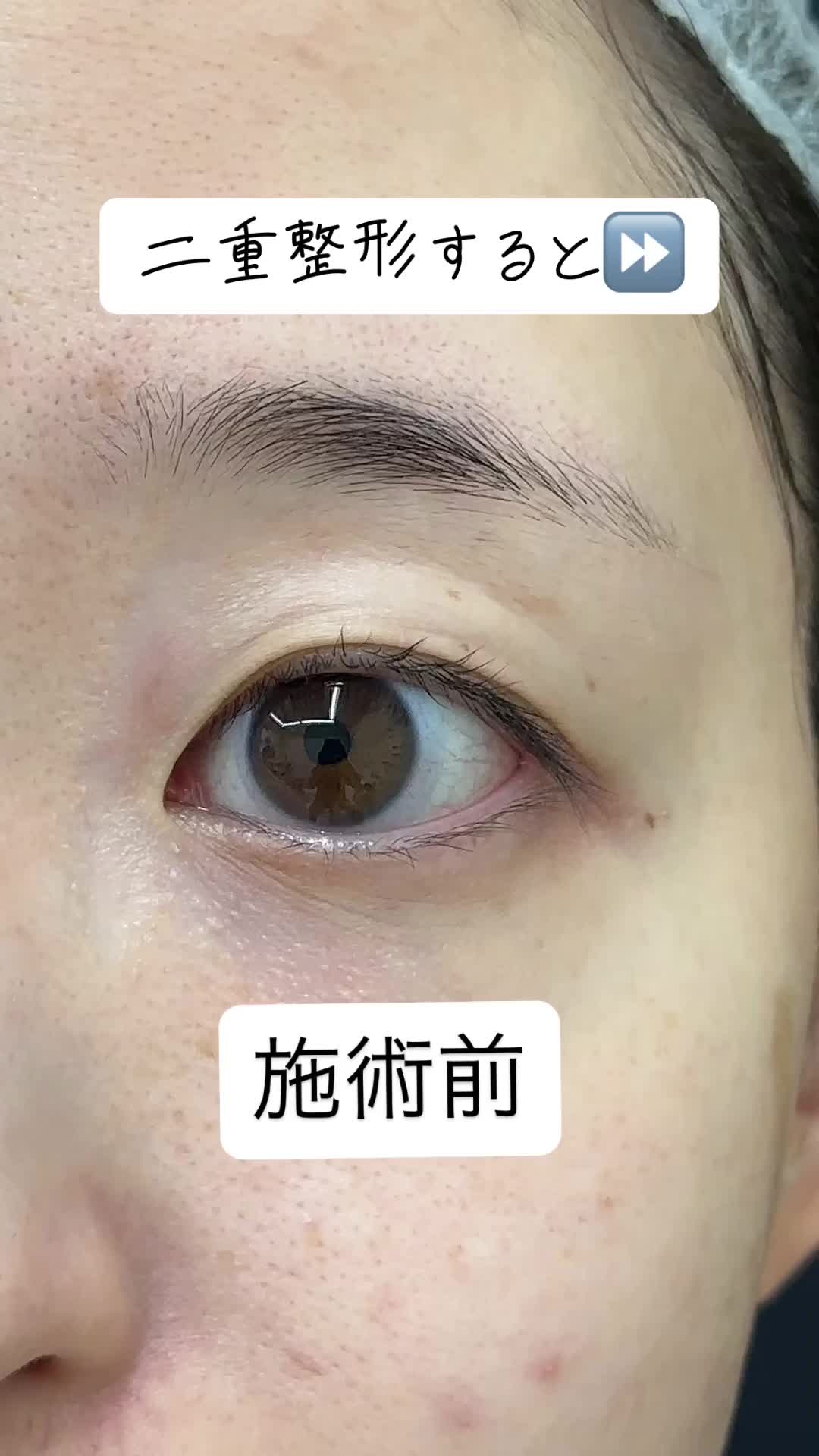@二重整形埋没法/広島美容外科メイプルクリニック院長 吉本如良