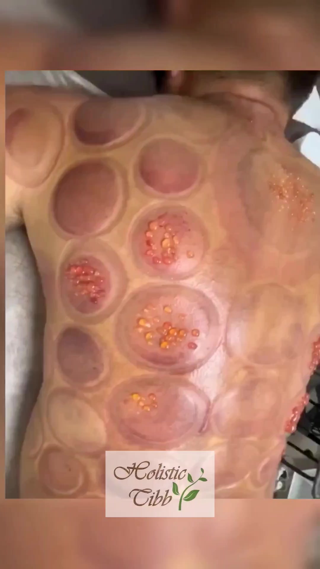 @Holistic Tibb Hijama