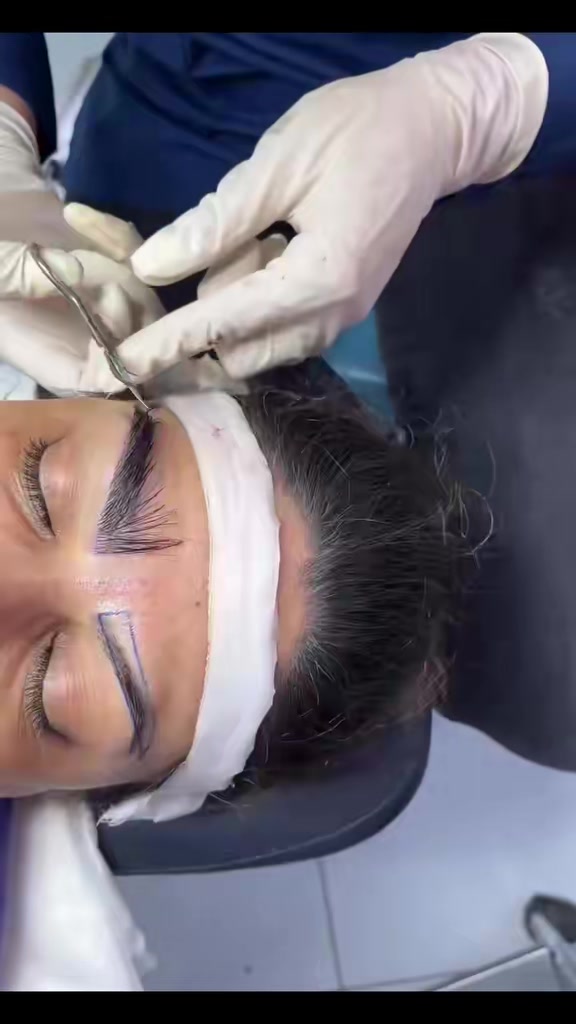 @Eyebrows Transplant