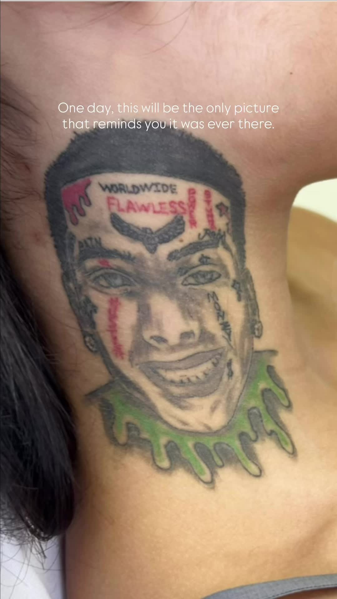 @@BHLASERTATTOOREMOVAL