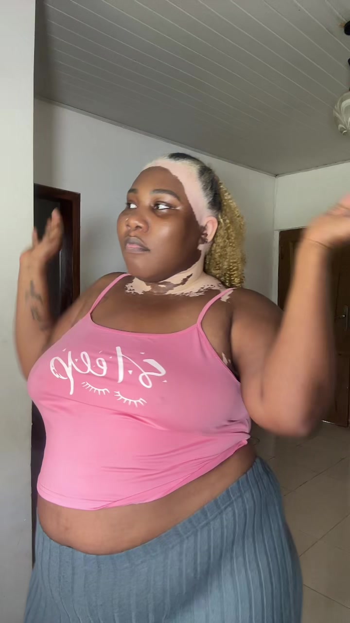@Thevitiligogirl