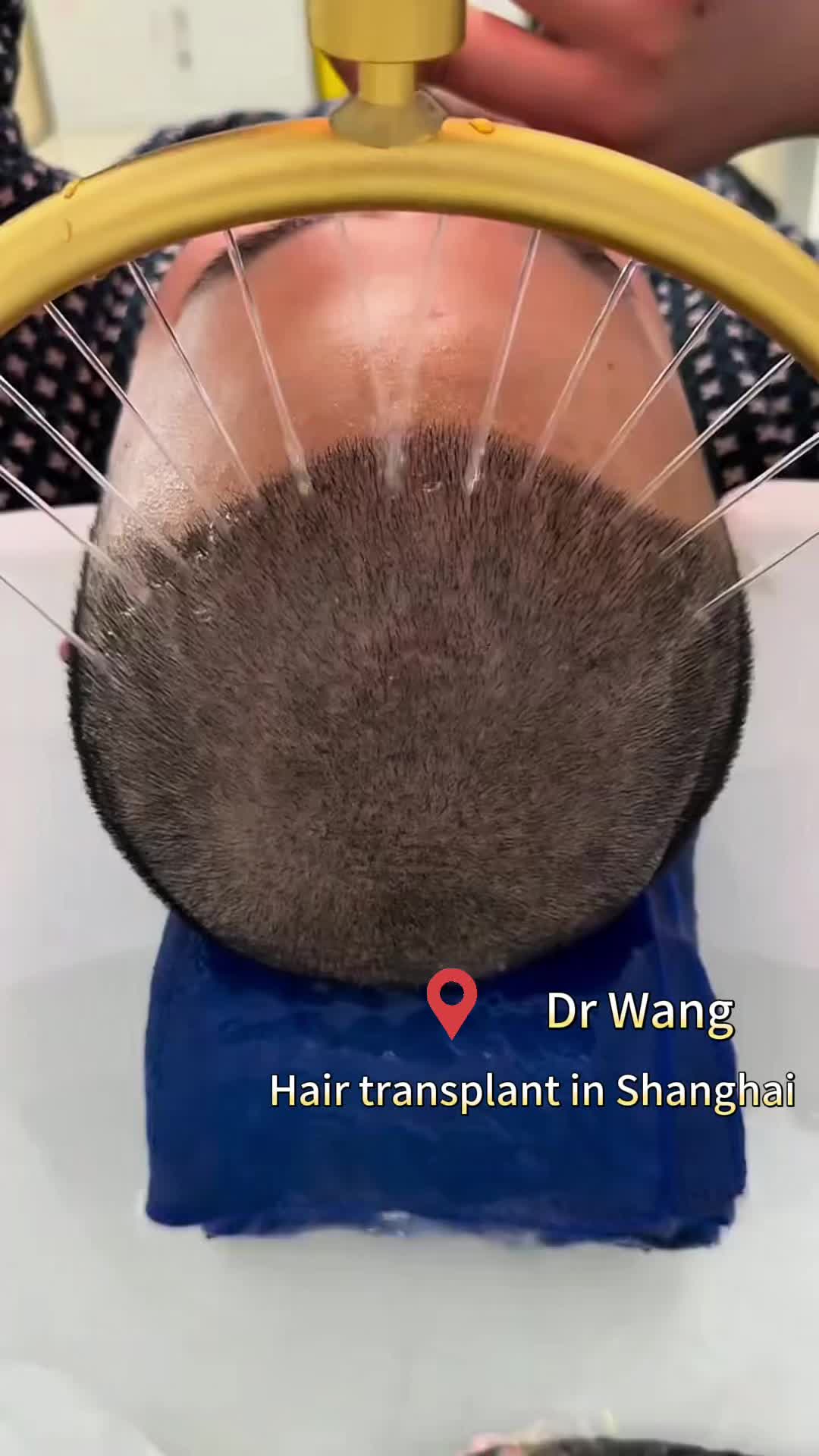 @HAIR TRANSPLANT WANG🇨🇳
